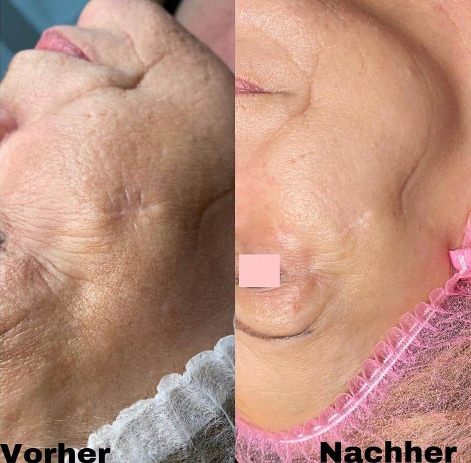 Vorher-Nachher Bild einer Kundin nach epigenetischer Gesichtsbehandlung