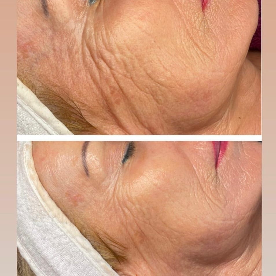 Vorher-Nachher Bild einer Kundin nach epigenetischer Gesichtsbehandlung