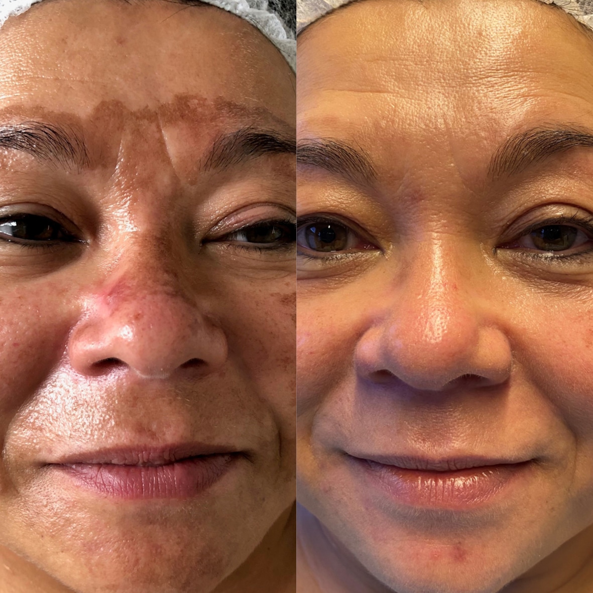Vorher-Nachher Bild einer Kundin nach epigenetischer Gesichtsbehandlung