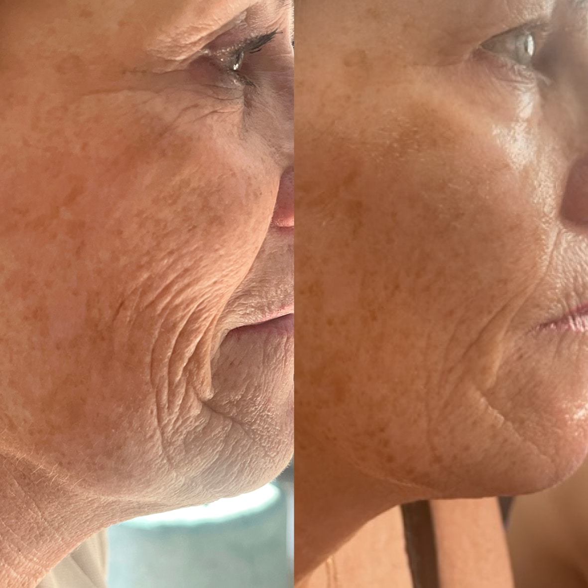 Vorher-Nachher Bild einer Kundin nach epigenetischer Gesichtsbehandlung