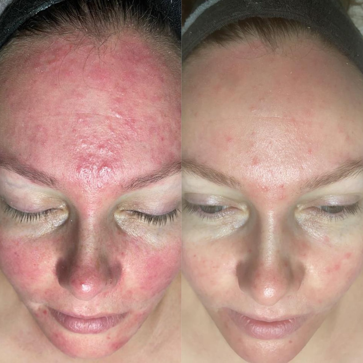 Vorher-Nachher Bild einer Kundin nach epigenetischer Gesichtsbehandlung