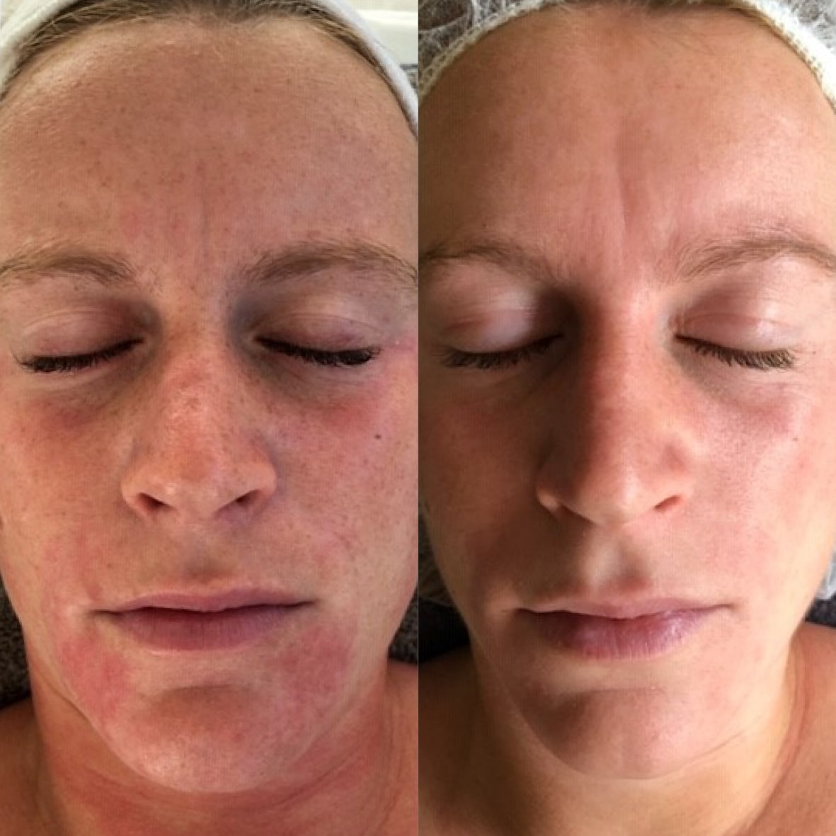 Vorher-Nachher Bild einer Kundin nach epigenetischer Gesichtsbehandlung