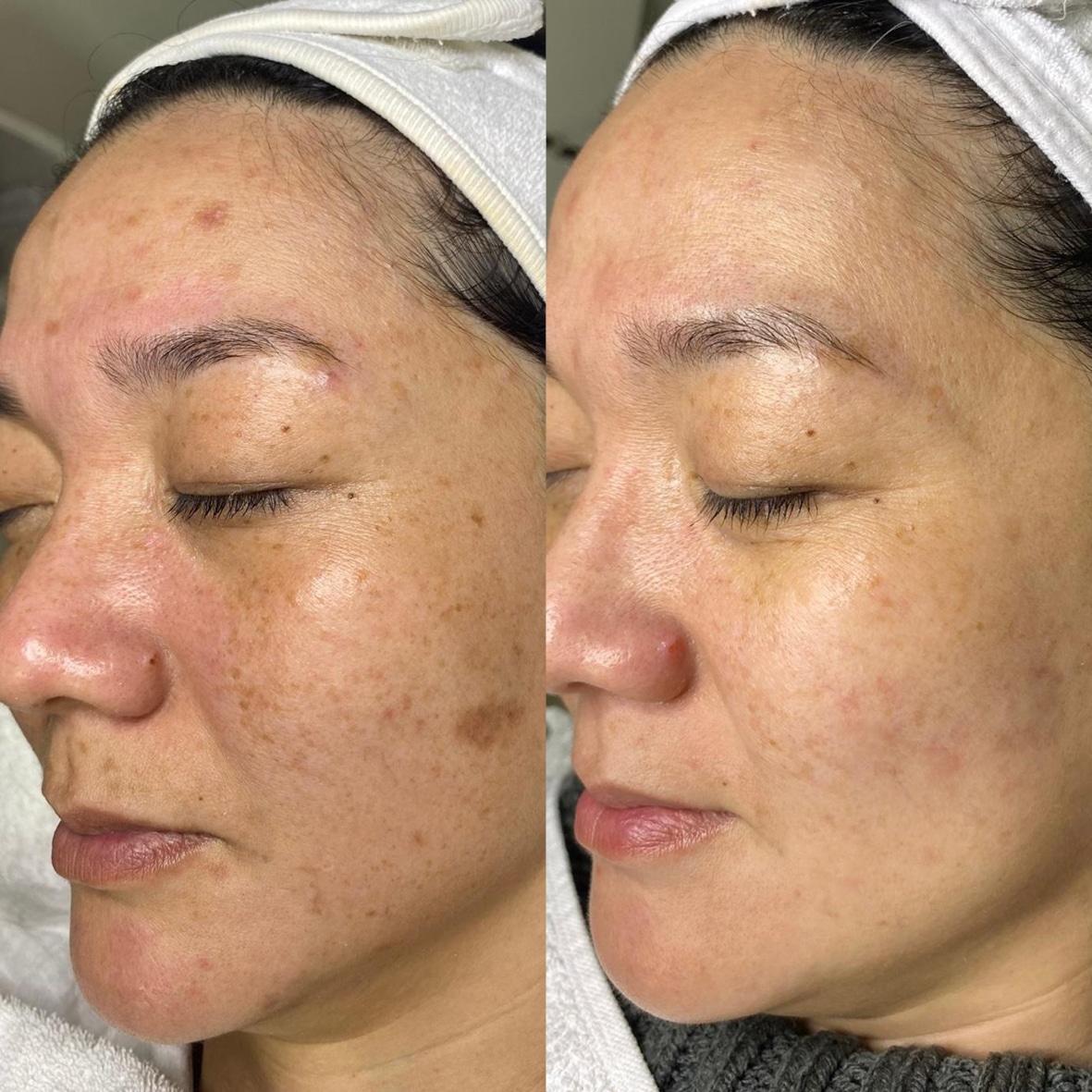 Vorher-Nachher Bild einer Kundin nach epigenetischer Gesichtsbehandlung