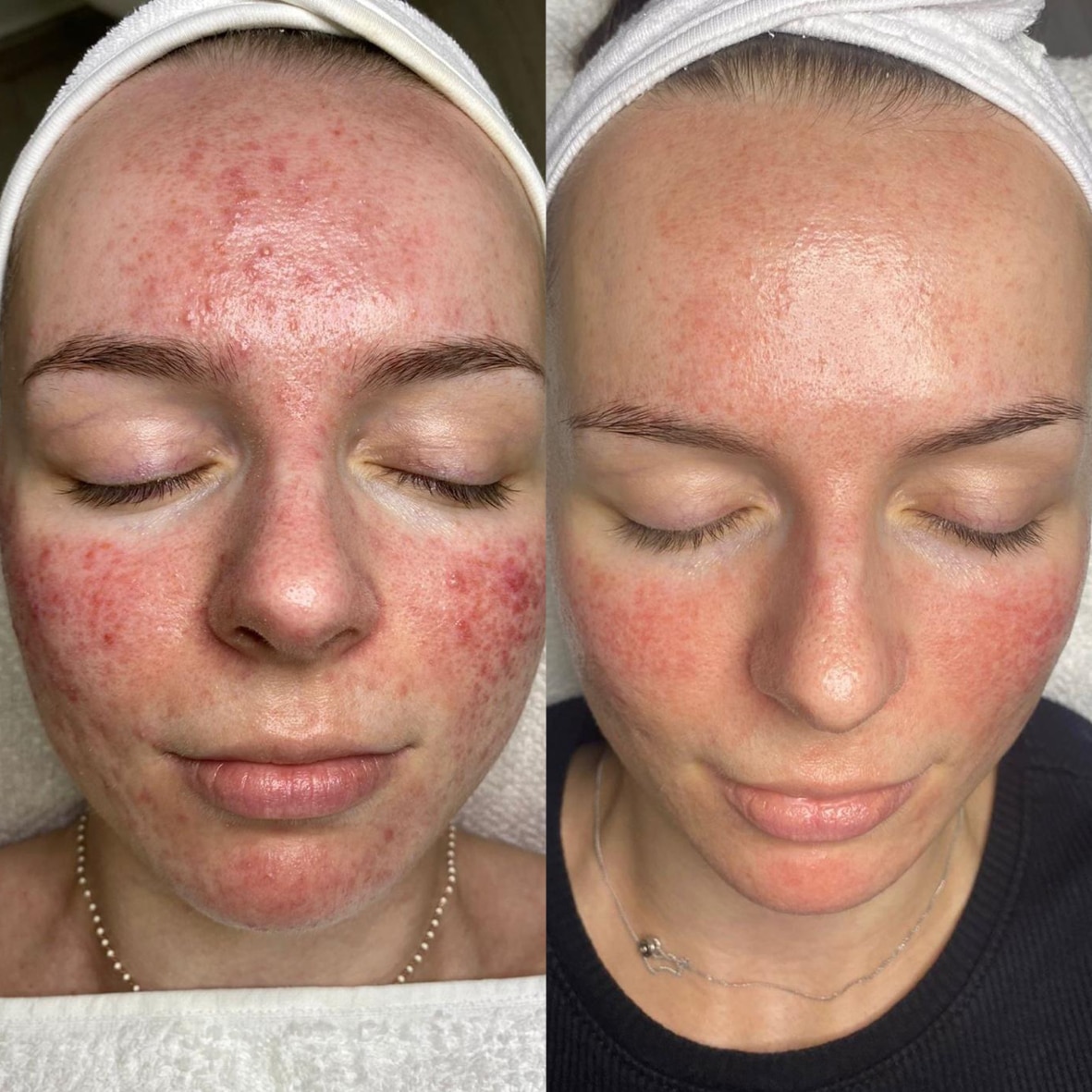 Vorher-Nachher Bild einer Kundin nach epigenetischer Gesichtsbehandlung