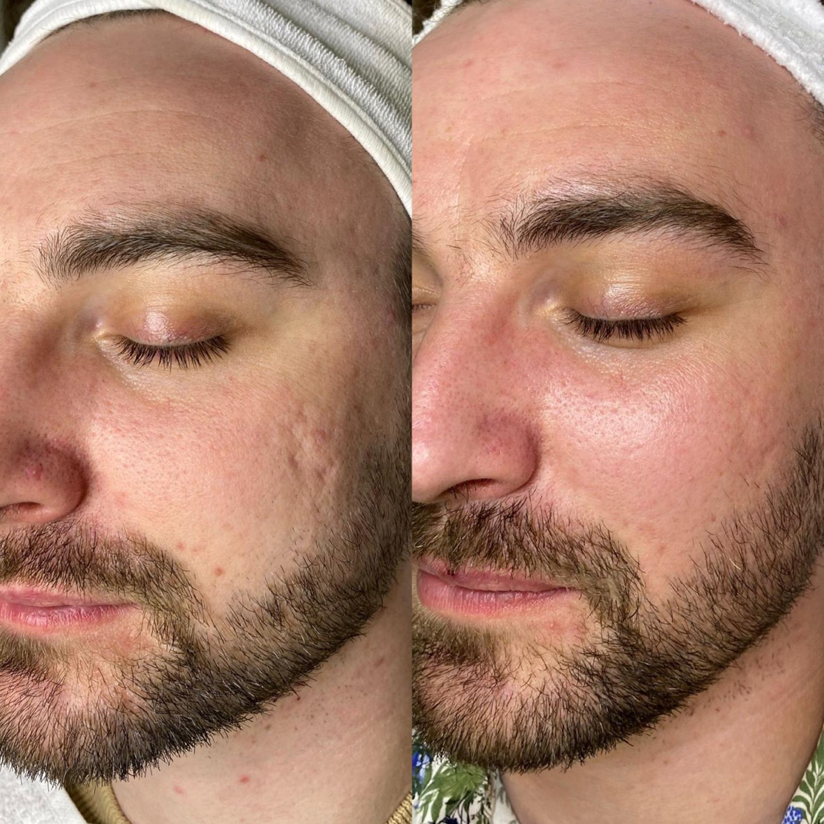Vorher-Nachher Bild eines Kunden nach epigenetischer Gesichtsbehandlung